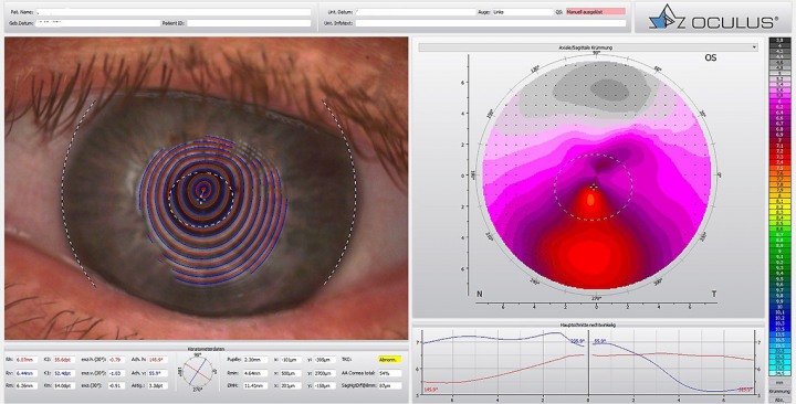 Keratoplastik_1_1140px